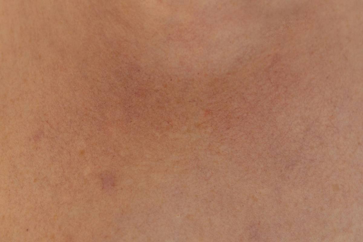 Before and after photos showing reduced facial redness in two clients using tailored anti redness makeup routines for sensitive skin.